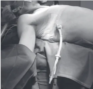 Figure  1  -  One-way  flutter  valve  attached  to  the  chest  tube in the immediate postoperative period