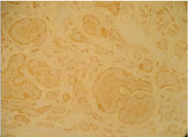 Figure 3 - Immunohistochemistry: chromogranin-positive  cells.