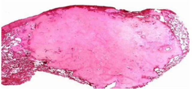 Figure  3  -  Histopathological  section  showing  Congo  red-positive material.