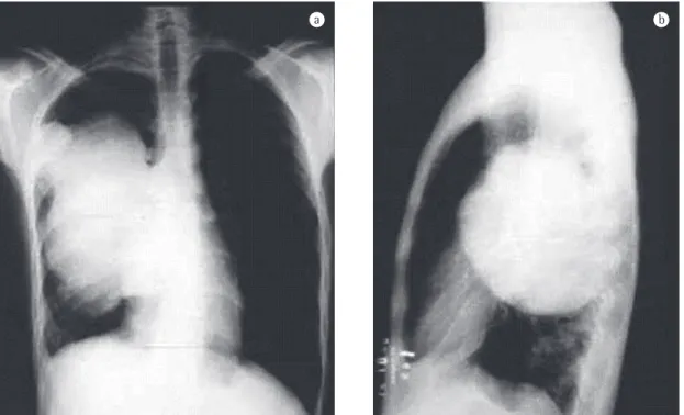 Figure 1 - Anteroposterior (a) and lateral right (b) chest X-ray showing the large right pulmonary mass, with clear  hilar involvement.