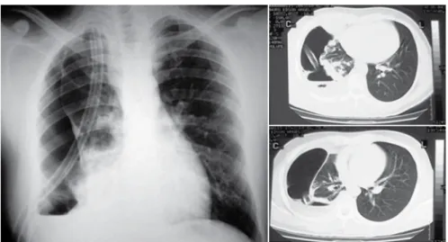 Figure 1 - Chest X-ray and tomography of the chest in Case 1. Note the spontaneous pneumothorax and various peripheral  nodules, some of which were later shown to be cavitated, revealing that it was a metastatic adamantinoma