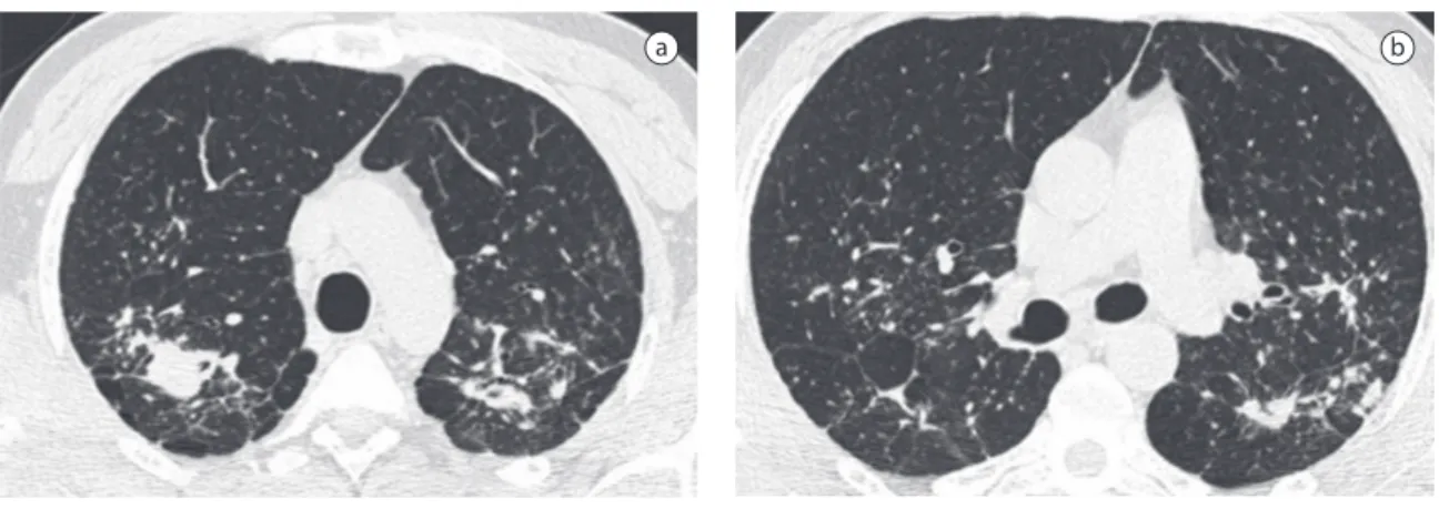 Figure  1  -  Example  of  extent  of  disease  scored  using  high-resolution  computerized  tomography  in  a  42-year-old  man with silicosis