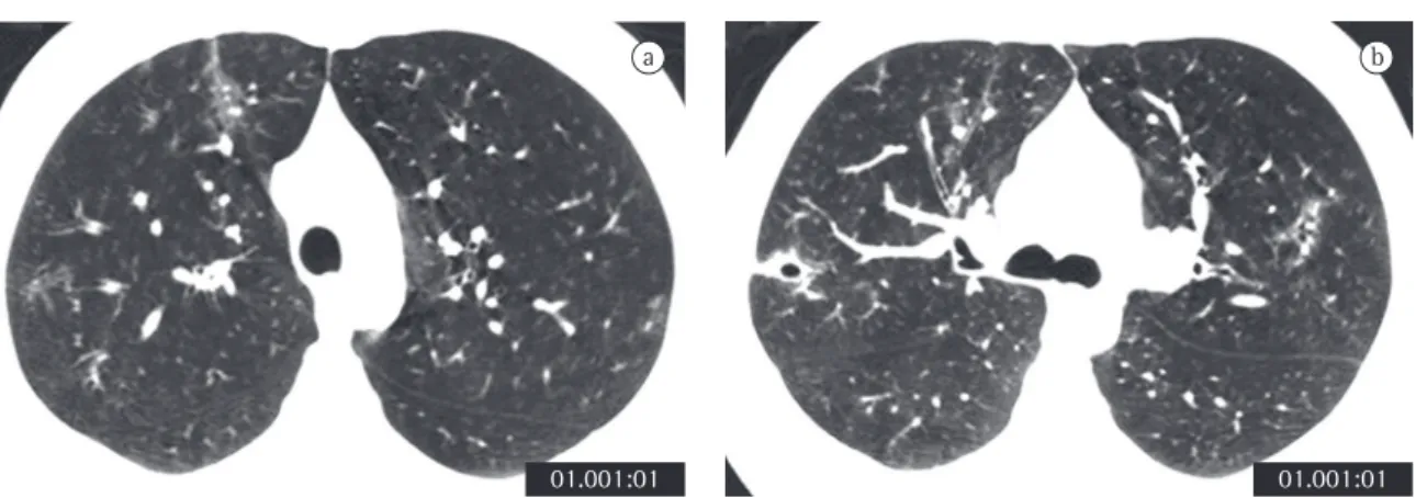 Figure 3 - High-resolution computed tomography scan performed 15 days after the first scan (after discontinuation  of drug use and initiation of corticosteroid therapy), with slices at the level of the aortic arch (a) and at the level of the  bronchial bif