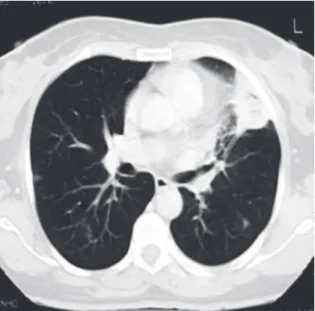 Figure  1  -  Pretreatment  computed  tomography  scan  of  the  chest  showing  a  4-cm  heterogeneous  mass  with  pleural  extension  at  the  level  of  the  lingula  and  two  micronodules  in  the  posterior  region  of  the  right  lung  field.