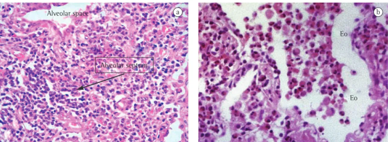 Figure 1 - Chronic eosinophilic pneumonia: a) detail of the septal alveolar thickening (arrow) caused by eosinophil  and mononuclear cell infiltration, H&amp;E ×200; and b) infiltration by eosinophils (Eo) throughout the alveolar septa and  within the alve
