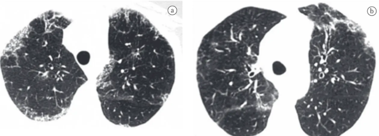 Figure 3 - High-resolution computed tomography scans of the chest (a and b), performed in May 2004, showing no  changes, except for an improvement in the alveolar opacity in the left upper lobe.