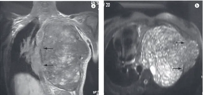 Figure  1  -  a)  Magnetic  resonance  image  showing  a  mass  occupying  the  entire  hemithorax  and  displacing  the  mediastinum to the right, with a cleavage plane next to the mediastinum (arrows); and b) Cross-sectional magnetic  resonance image sho