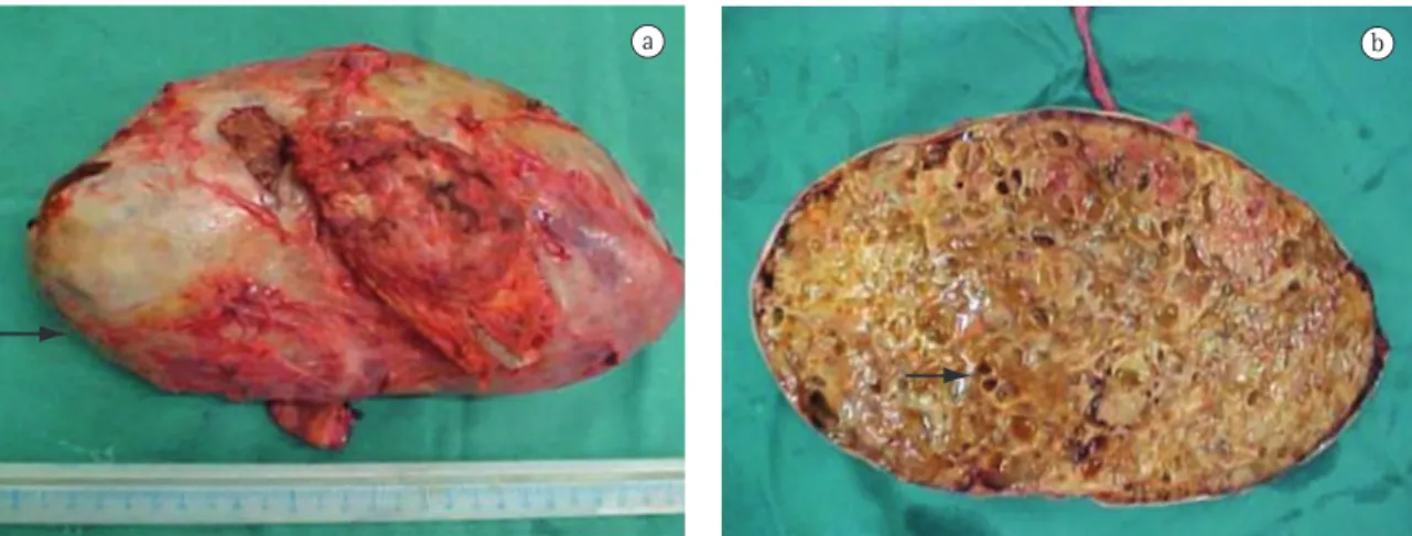 Figure 2 - a) Surgical sample: solid, encapsulated tumor with a well-defined capsule (arrow); and b) Tumor section  showing the internal aspect: a trabecular pattern typical of bone (arrow).