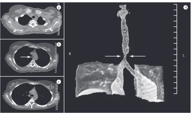Figure 1 - Computed tomography scan of the chest: Axial slices (a, b, and c); and three-dimensional reconstruction  (d) showing the tracheal stenosis (white arrows).