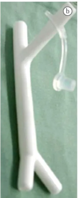 Figure 2 - Tracheal stent: Damaged trachea measurements based on the computed tomography scan of the chest with  three-dimensional reconstruction (a) and adapted tracheobronchial stent (b).