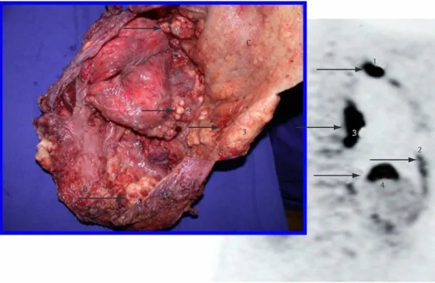 Figure 2 - Correlation between the positron emission tomography (PET) scan and the intraoperative finding