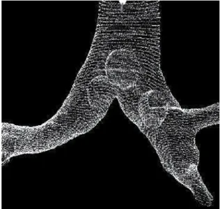 Figure 6 - Neurofibromatosis. Three-dimensional (volume  rendering) reconstruction of the trachea and main bronchi  in which one can identify, by transparency, three nodular  polypoid  images,  with  regular  borders,  located  in  the  carina and in each 