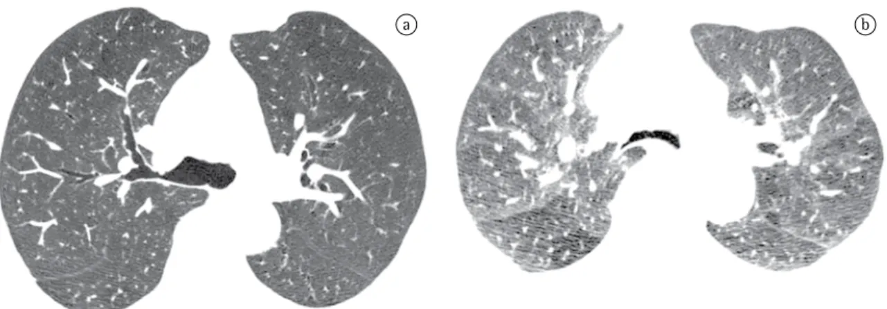 Figure  9  -  a)  Tracheobronchomalacia.  Slice  obtained  during  the  inspiratory  phase,  at  the  level  of  the  bronchial  bifurcation, showing the main bronchi to be of normal caliber; and b) Tracheobronchomalacia