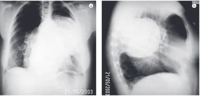 Figure 1 - Chest X-rays: a) Anteroposterior; and b) Lateral: presence of retrocardiac opacity in both hemithoraces, the  one on the left being spherical (10 cm in diameter) and positioned higher than the one on the right, which is more  elongated and proje