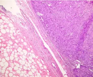 Figure  3  -  Photomicrograph  showing  the  border  between  the  two  histopathological  variants:  to  the  left,  the  well-differentiated  liposarcoma;  and,  to  the  right,  the dedifferentiated liposarcoma (hematoxylin and eosin  staining, magnific