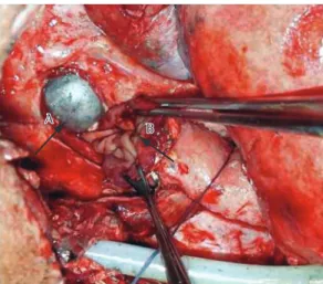 Figure 1 - Tracheal lesion. Initial aspect of the tracheal  lesion (tracheal cuff herniation; arrow a)