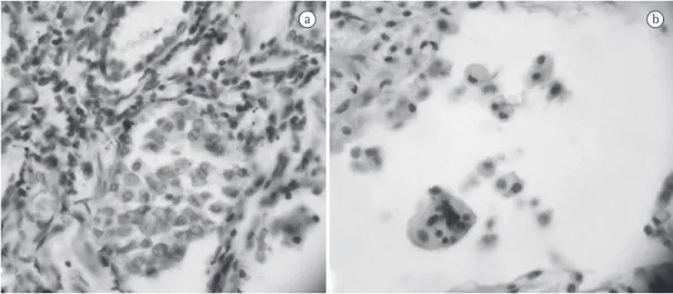 Figure 2 - In a), anatomopathological examination showing macrophages in the alveolar lumen, consistent  with desquamative pneumonia (H &amp; E; magnification, ×400); in b), anatomopathological examination revealing  the presence of giant cells (H&amp;E; m