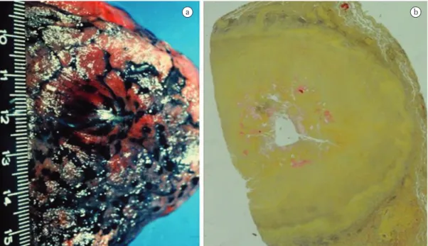 Figure 4 - Cryptococcoma. Nodule in the pulmonary cortex causing pleural bulging (a). Histological section  presenting yeasts with carminophilic capsule inside the cryptococcoma (b)