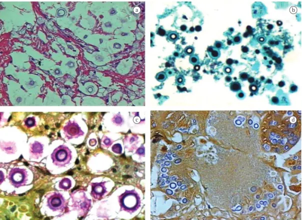 Figure 5 - Structures arranged extracellularly. Absence of inflammatory response. Note complete destruction  of tissue architecture—minimally reactive histological pattern