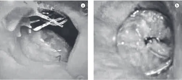 Figure 2 - In a), complete stump fistula after right pneumonectomy. In b), appearance of the site immediately  after the device had been placed.