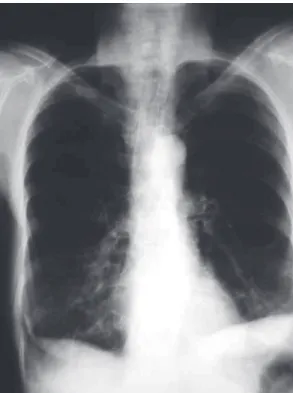 Figure 1 - Initial chest X-ray of the patient showing  lung  hyperinflation  and  severely  decreased  vascular  markings in the upper halves of both lung fields.