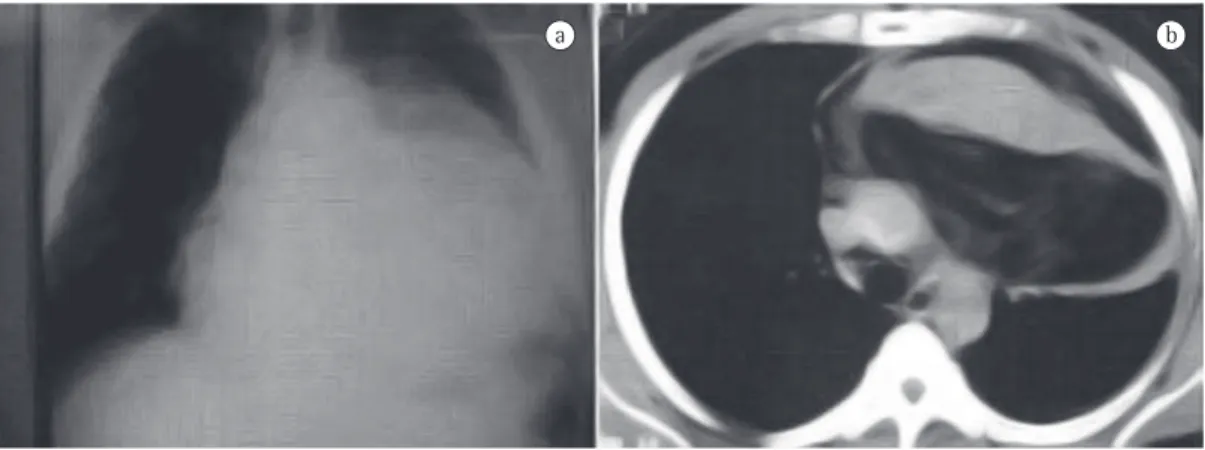 Figure  1  -  a)  Chest  X-ray  revealing  opacity  in  the  mediastinum  and  in  the  left  hemithorax,  resembling  cardiomegaly