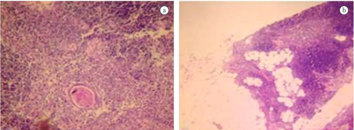Figure 3 - a) Photomicrograph of the specimen revealing a Hassall’s corpuscle surrounded by normal thymic  tissue (H&amp;E; magnification, ×100)