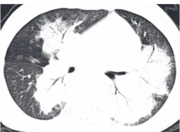 Figure 3 - HRCT scan of the chest of the same child  (see  Figure  2)  after  the  treatment