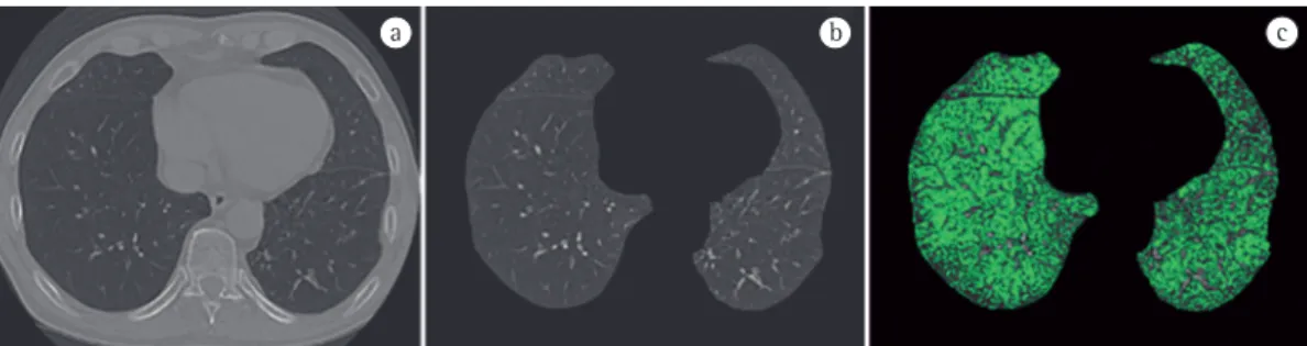 Figure  5  - Example of segmentation of a HRCT image of a patient with COPD performed by the  SIStema  para a Detecção e a quantificação de Enfisema Pulmonar  (SISDEP, System to Detect and Quantify Pulmonary  Emphysema)