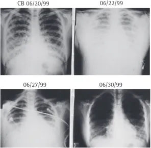 Figure  2  -  Radiological  evolution  of  hantavirus  cardiopulmonary syndrome in an adolescent who was  infected with the Araraquara hantavirus and survived  the  disease