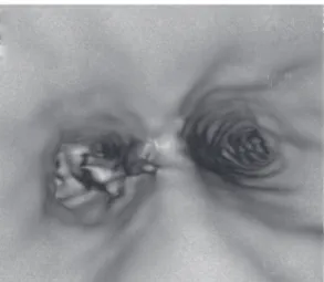 Figure 3 - Virtual bronchoscopy of the patient in case  2 evidencing the endobronchial foreign body.