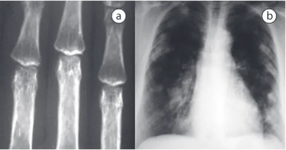 Figure  1  -  In  a),  hand  X-rays  showing  a  symmetric  decrease  in  joint  spaces,  marginal  bone  erosion,  and  periarticular  osteoporosis  in  the  proximal  metacarpophalangeal  and  interphalangeal  joints