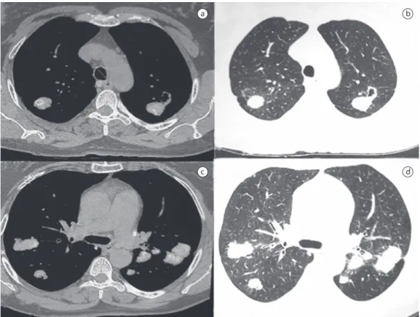 Figure  2  -  HRCT  images  showing  nodules  of  various  sizes,  1-5  cm  in  diameter,  rounded,  well  delimited,  distributed at the periphery of both lungs, affecting the upper and lower halves of the lungs, and larger, also  peripheral, masses in bo