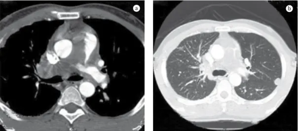 Figure 1 - a) Large filling defect in the mediastinal and pericardial portions of the pulmonary arteries, there  being slight enhancement after intravenous administration of contrast material