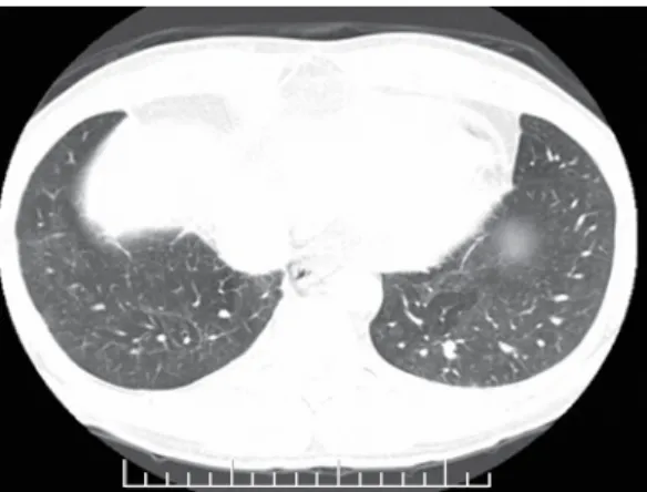 Figure 2 - Mosaic attenuation pattern.