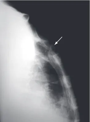 Figure 2 - Lateral X-ray of the sternum showing an  osteolytic  lesion  in  the  region  of  the  suprasternal  notch and in part of the costal arch (white arrow).