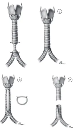 Figure  1  -  In  a),  resection  and  end-to-end  anastomosis:  The  stenotic  segment  is  resected,  and  both  tracheal  stumps  are  anastomosed