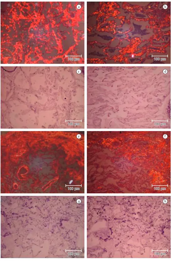 Figura 3 - Birrefringência forte, homogênea, vermelho laranja, no interstício na PINE idiopática (A), contrastando  com baixa birrefringência vermelho laranja observada na PINE-ES (B)