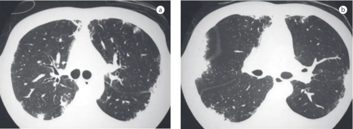 Figure  2  -  Drug-induced  chronic  eosinophilic  pneumonia.  Patient  diagnosed  with  leprosy  4  months  prior  and  under  treatment  with  dapsone
