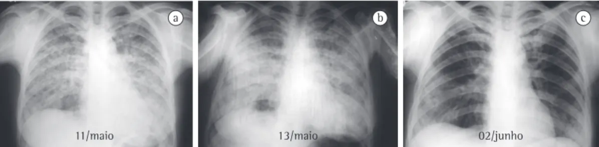 Figure 3 - Acute eosinophilic pneumonia due to a parasitic infection. Female patient admitted to the intensive  care unit with fever (39°C), severe dyspnea and cyanosis