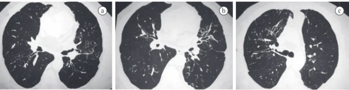 Figure 4 - Allergic bronchopulmonary aspergillosis. A 37-year-old male patient with severe, corticosteroid- corticosteroid-dependent  asthma