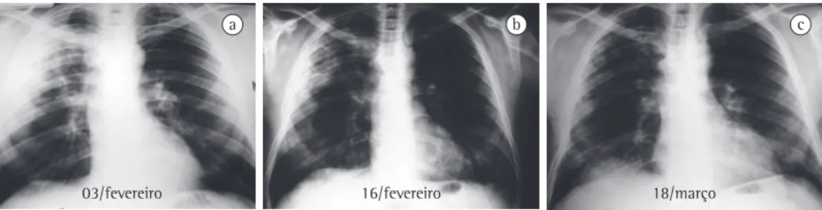 Figure 5 - Churg-Strauss syndrome. Thirty-eight-year-old male asthmatic admitted with a history of dyspnea,  hemoptysis, fever, weight loss (10 kg), paresthesia and loss of left foot strength