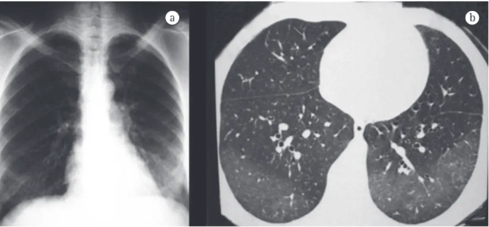 Figure  6  - Hypereosinophilic syndrome. A 39-year-old female patient with persistent eosinophilia (33-61% 