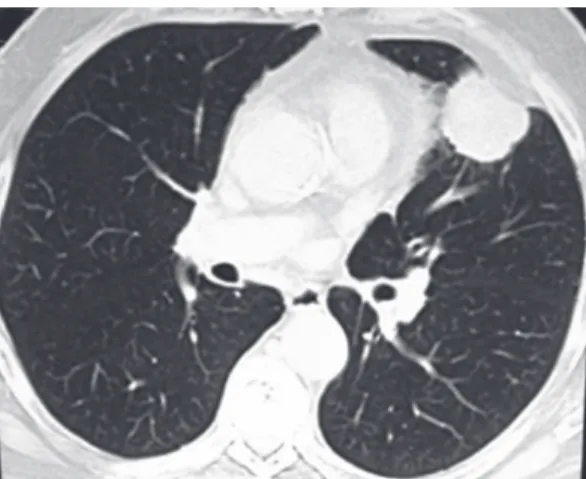 Figure 1 - CT scan of the thorax performed in 2002,  revealing a nodular lesion with dense soft parts and  lobulated,  slightly  spiculated  borders,  located  in  the  lingula and measuring approximately 4.0 cm.