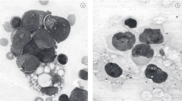 Table 1 - Immunohistochemical profile of the tumor  cells. Markers Result  CD99  Positive  CD45  Negative  AE-1/AE-3  Negative  Chromogranin  Negative  Desmin  Negative  Myogenin  Negative  S-100 protein  Negative  TdT  Negative  Vimentin  Negative