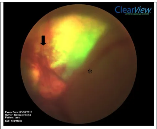 Figura 12. Fotografia da retina de cão com erliquiose. Notar coriorretinite, hemorragia (seta) e descolamento  de retina (asterisco)