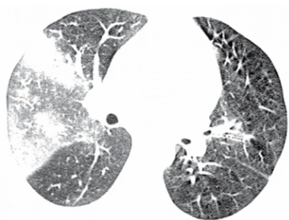 Figure  5  -  HRCT  scan  at  the  level  of  lower  lobes  showing  a  well-defined  area  of  ground-glass  opacity  in  the  right  lower  lobe  in  a  12-year-old  male patient with  Staphylococcus aureus  pneumonia  in  the  pre-engraftment  period  a