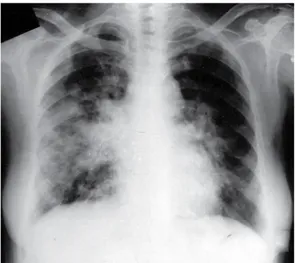 Figure 1 - Anteroposterior chest X-ray, taken 9 months  prior to referral, showing diffuse, patchy opacities in  both lungs, together with bilateral hilar enlargement
