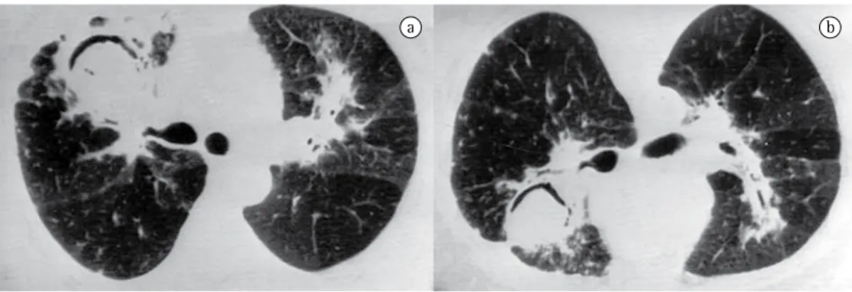 Figure 3 - CT scans of the chest obtained after referral: (a) well-defined cavitary lesion in the anterior segment  of the right upper lobe; and (b) positional change of the mass within the cavity in the prone position.