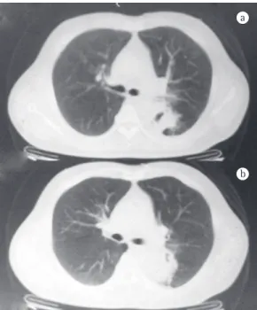 Figure 1 - Chest CT scan showing an irregular mass  in the left lower lobe.